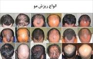 درمان ریزش مو,محلول رویش مو دکتر نوروزیان