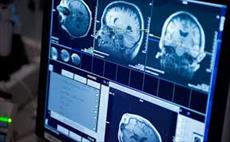 پاورپوینت ارزیابی خونریزی های مغزی در MRI